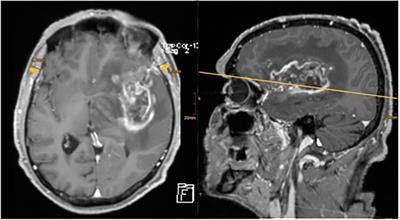 Temporal muscle thickness has no prognostic relevance in patients with high-grade glioma compared to functional scales